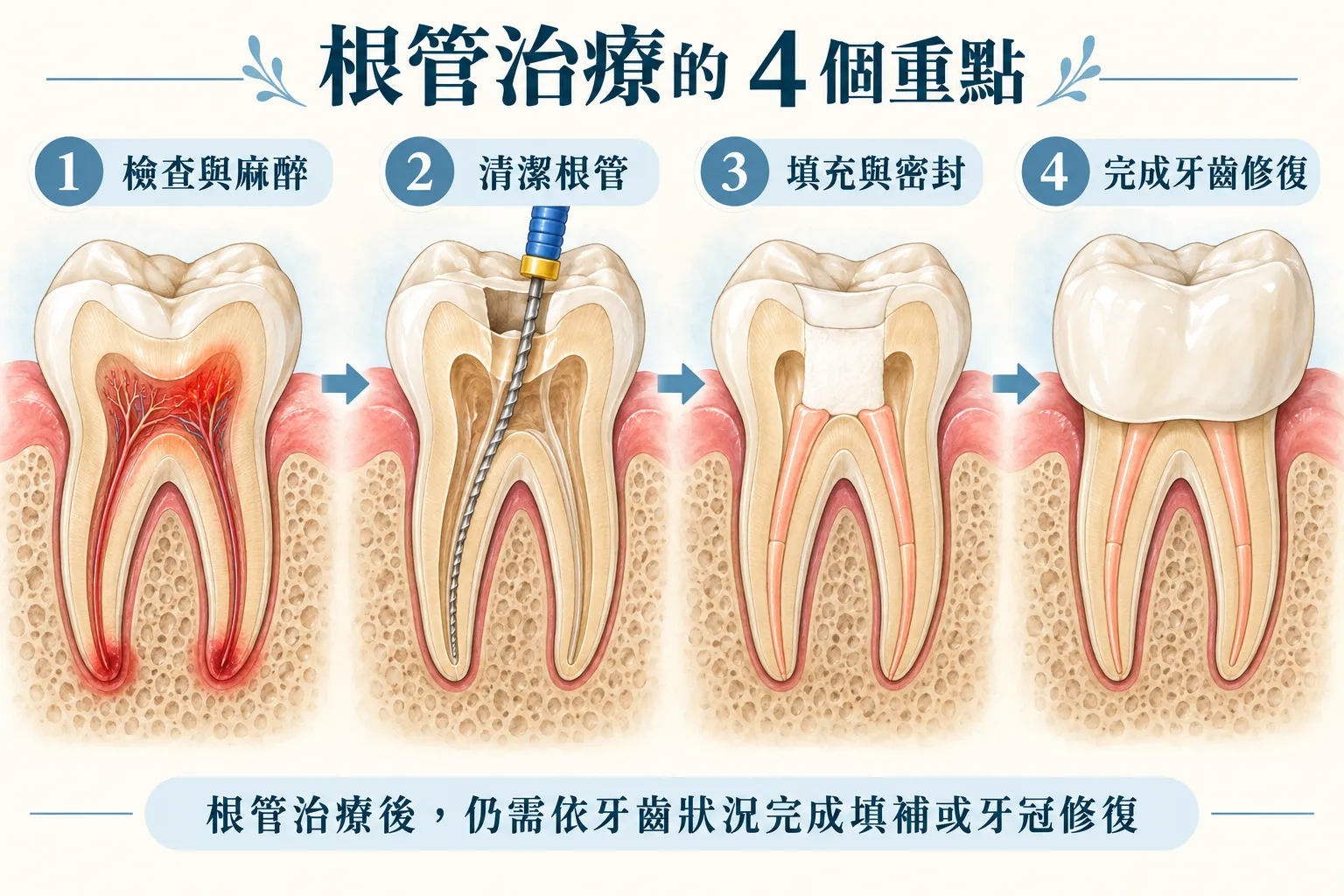 根管治療就是抽神經嗎?治療流程、牙冠與術後照護 根管治療就是抽神經嗎?治療流程、牙冠與術後照護