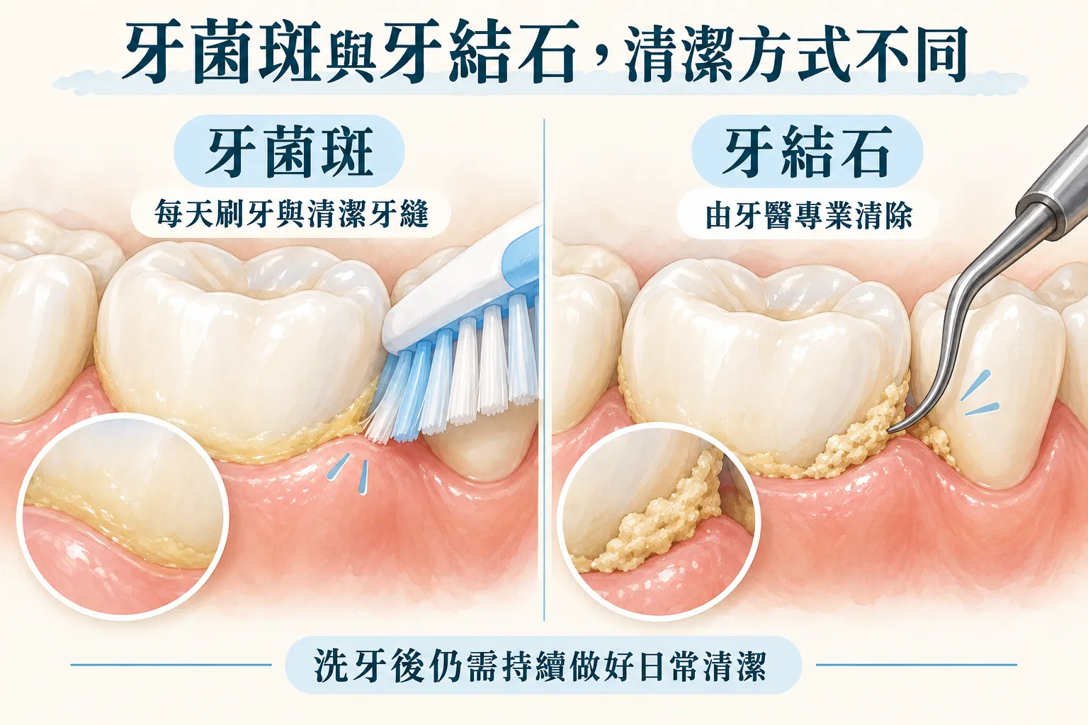 洗牙會傷牙齒嗎?牙結石、洗牙後敏感與日常照護 洗牙會傷牙齒嗎?牙結石、洗牙後敏感與日常照護